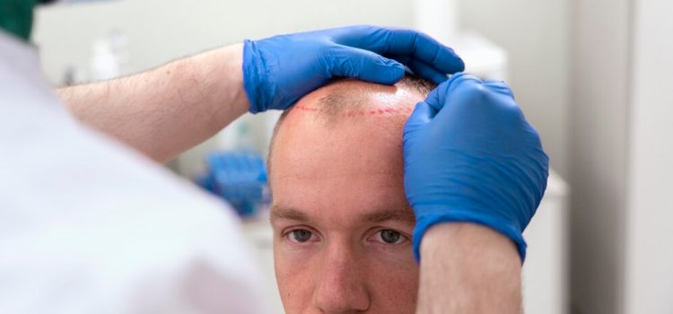 De ce FUE este cea mai sigură opțiune pentru transplanturile de păr